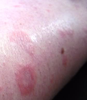 Pictures Of My Rash - Dermatitis Herpetiformis - Celiac ...